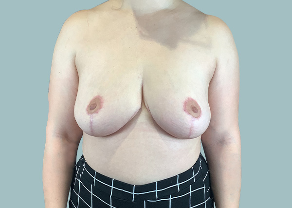 After Front