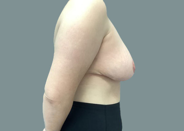 After reduction left