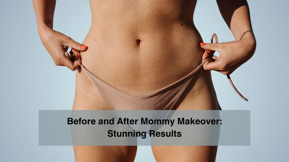 Before and After Mommy Makeover Stunning Results