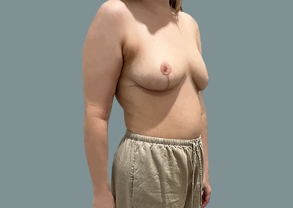 Breast Reduction After Right Oblique Patient 3
