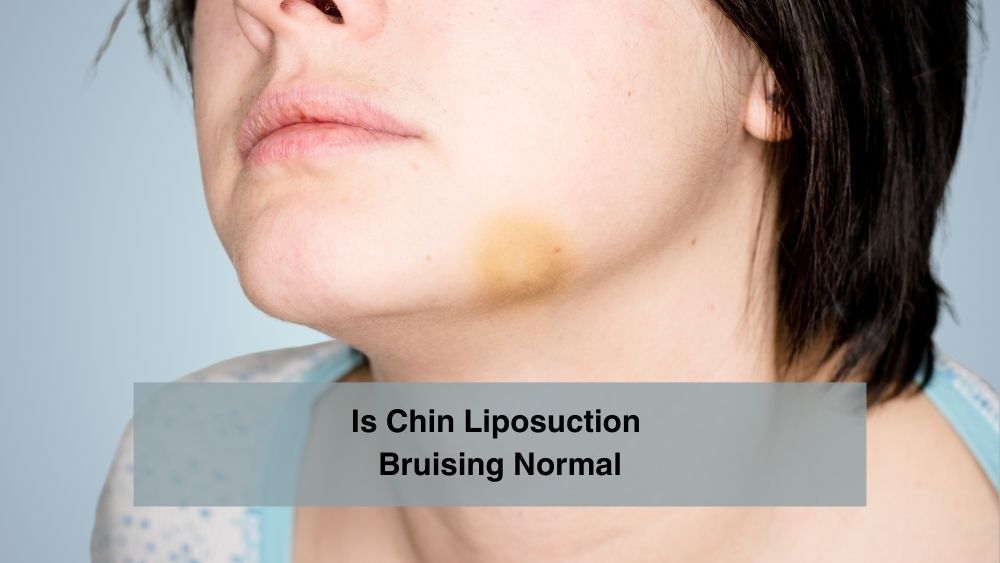 Is Chin Liposuction Bruising Normal
