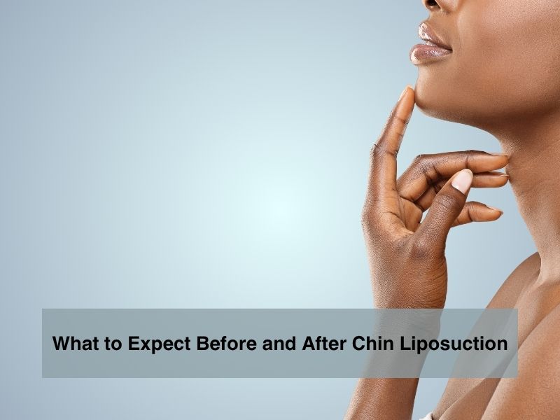 What to Expect Before and After Chin Liposuction