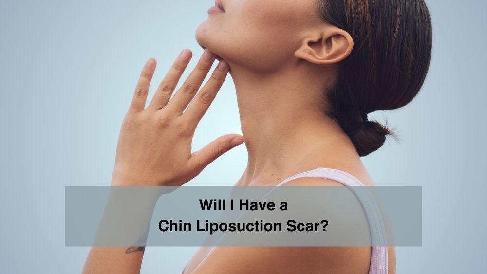 Will I Have a Chin Liposuction Scar