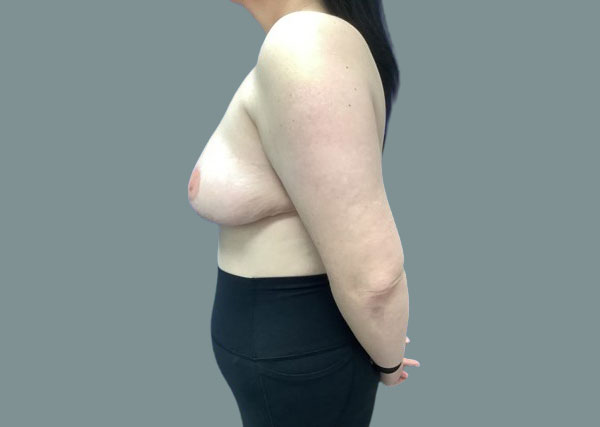 After reduction right