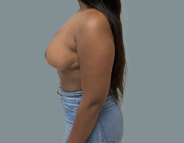 after left side