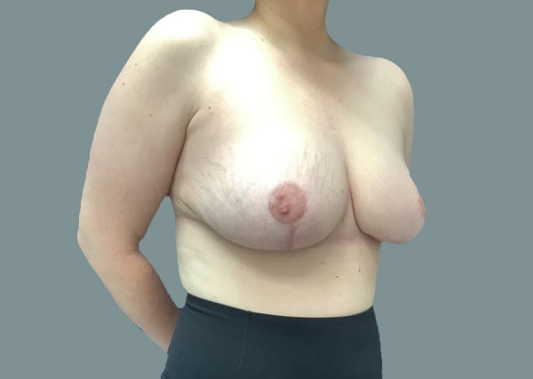 After reduction left oblique