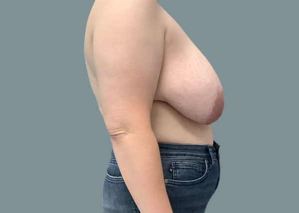 Before reduction left