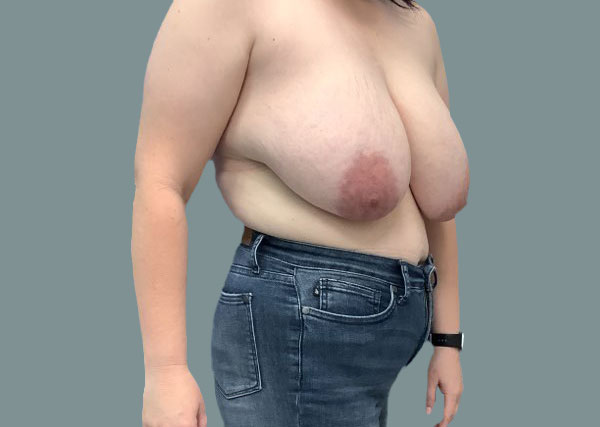 Before reduction left oblique