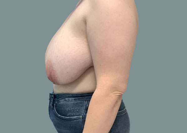 Before reduction right