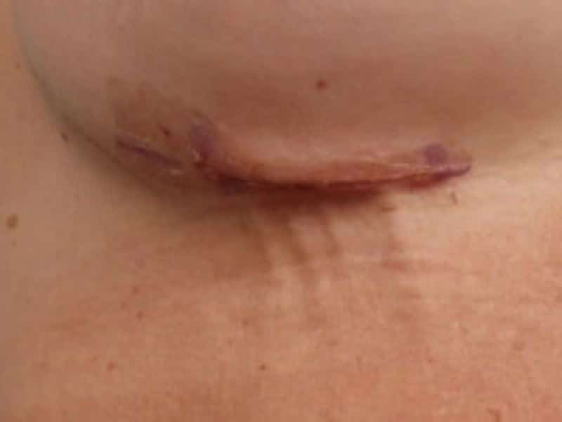 breast augmentation scar treatment 