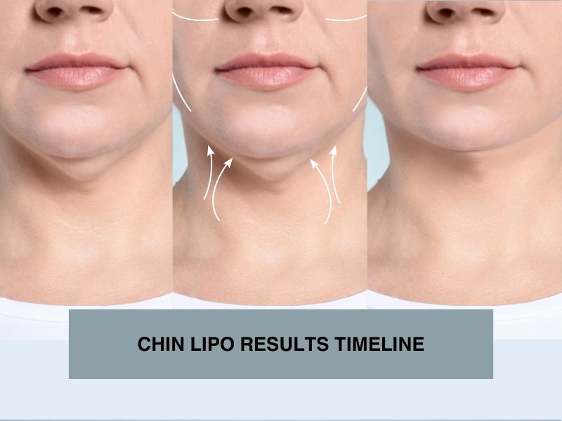 chin lipo results timeline