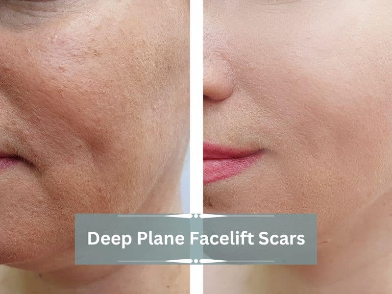 deep plane facelift scars