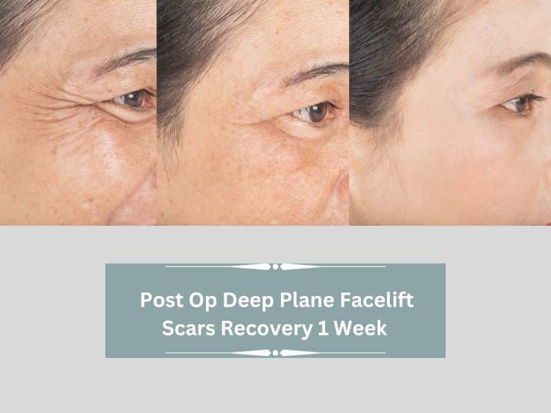 recovery 1 week post op deep plane facelift scars